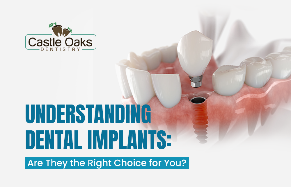 Dental Implants